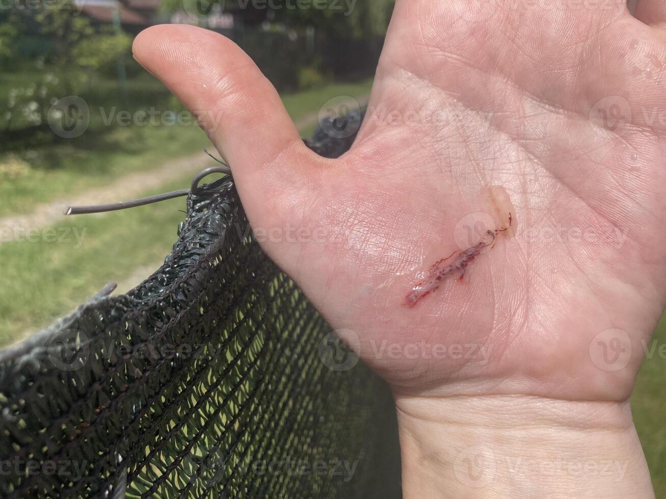 Wound cut on hand from wire photo