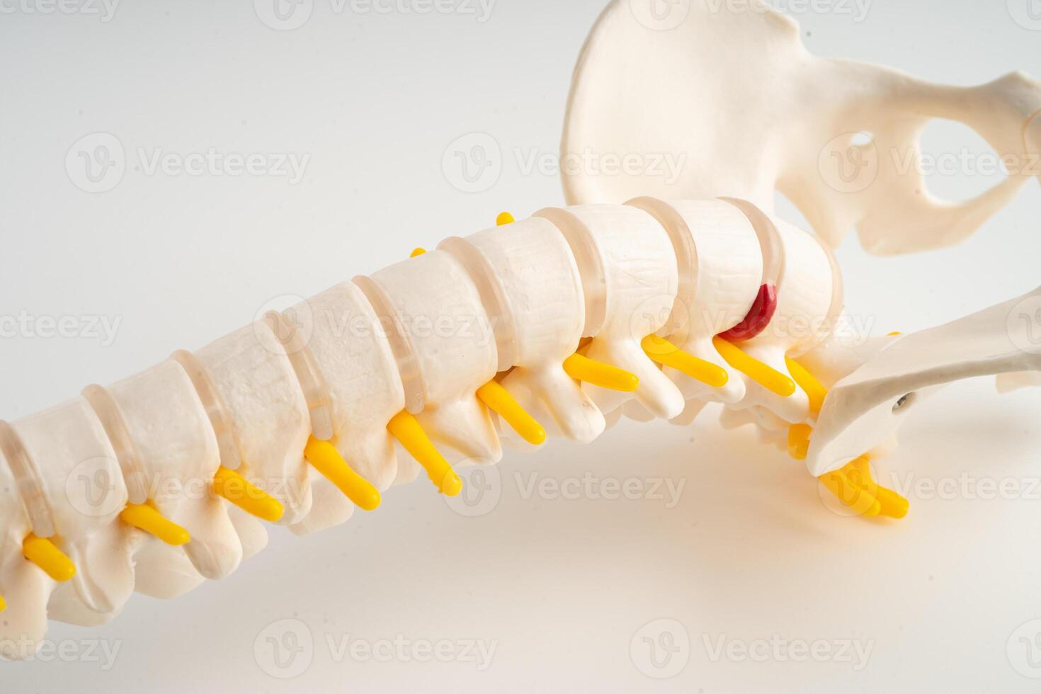 Lumbar spine displaced herniated disc fragment, spinal nerve and bone. Model for treatment medical in the orthopedic department. photo