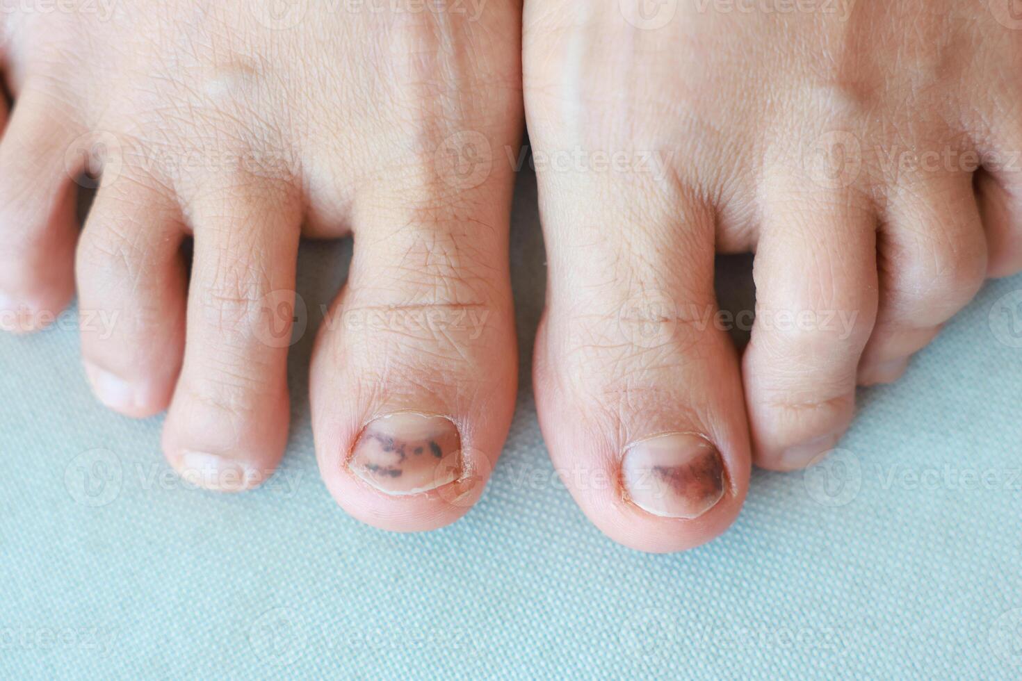 Subungual Hematoma on toenail are injuries of wearing shoes that are too tight in which bleeding develops under the nail. A crush injury to the distal phalanx fingernail or toenail, black toenail. photo