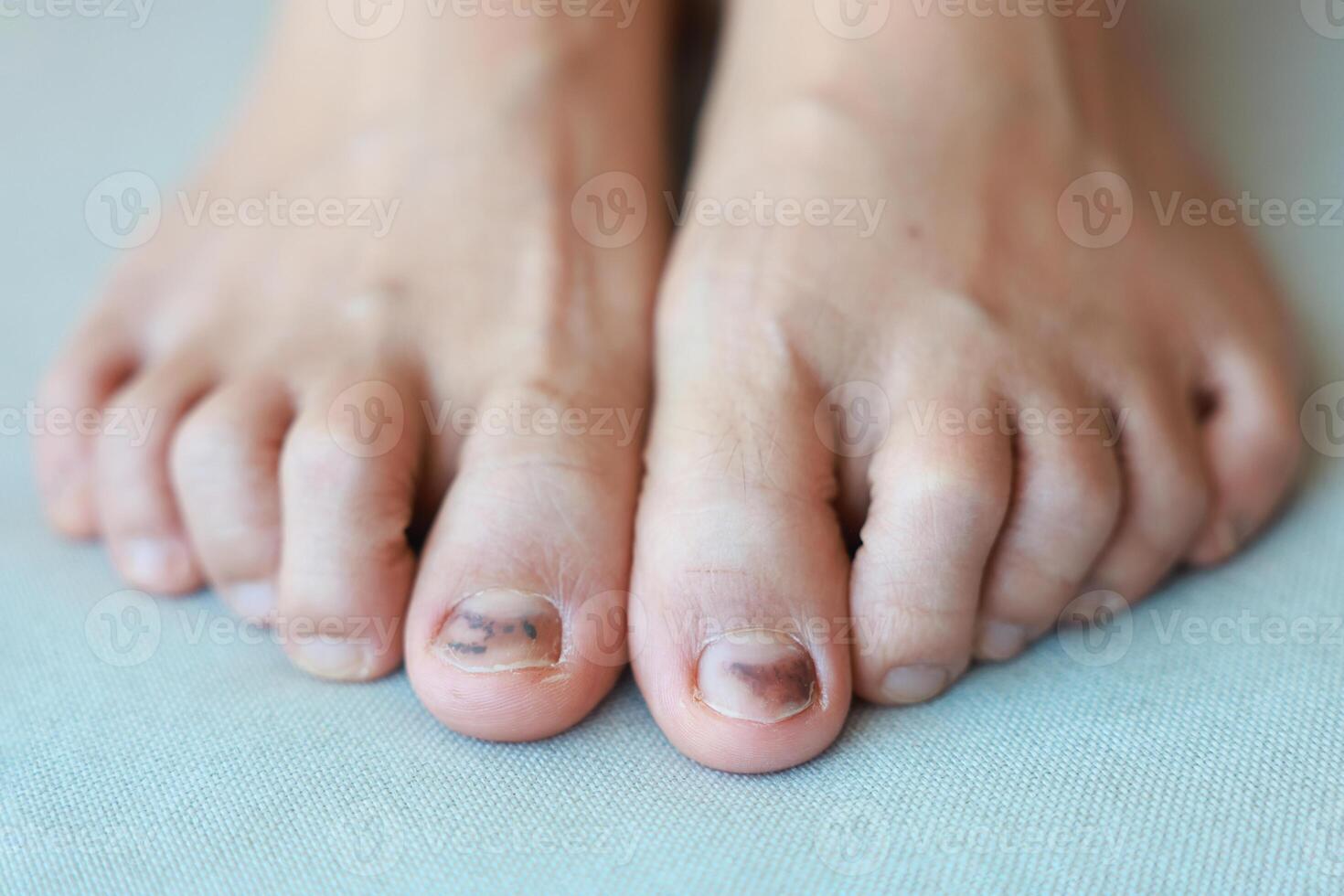 Subungual Hematoma on toenail are injuries of wearing shoes that are too tight in which bleeding develops under the nail. A crush injury to the distal phalanx fingernail or toenail, black toenail. photo