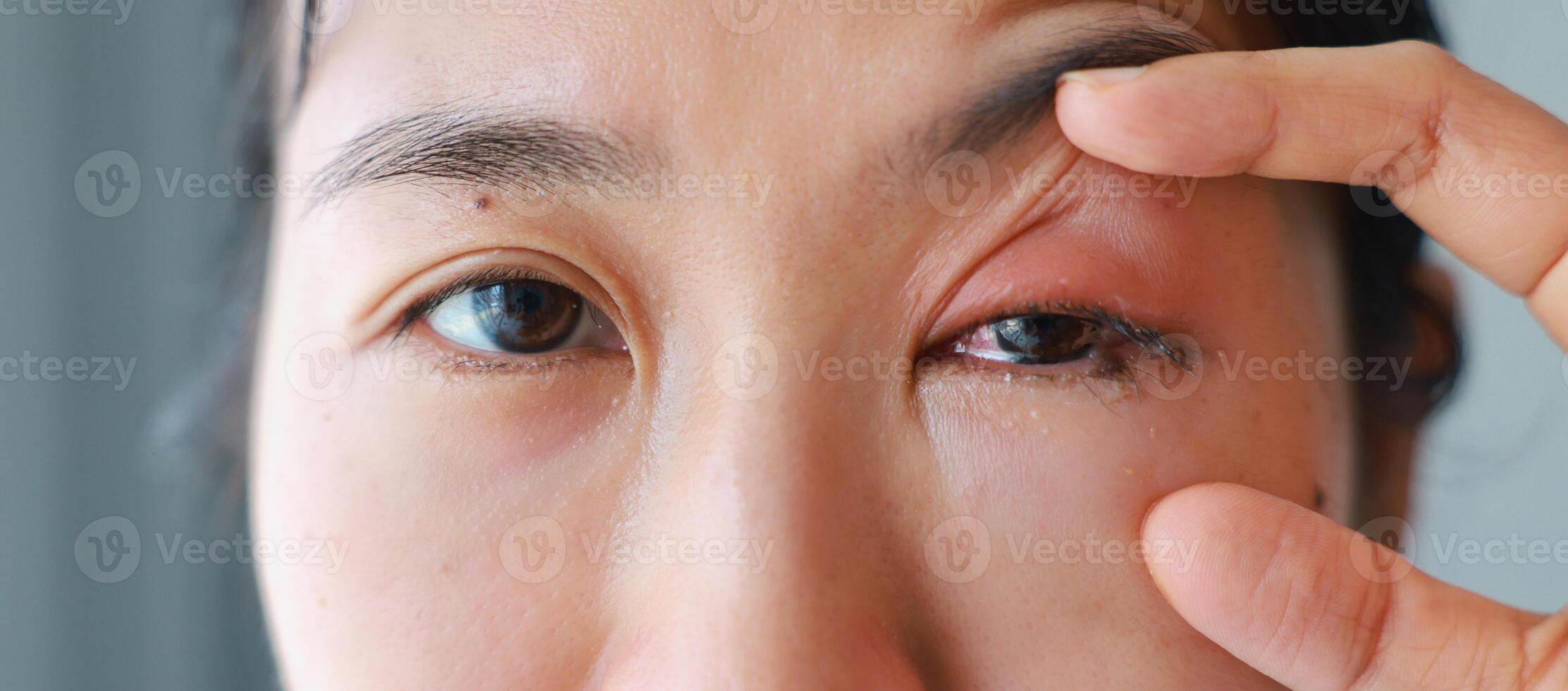 Woman's eyes become inflamed after rubbing her eyes violently. Insects entering eye cause irritation and wounds to cornea, causing eye to become swollen and red. Ophthalmologist treats eye infections. photo