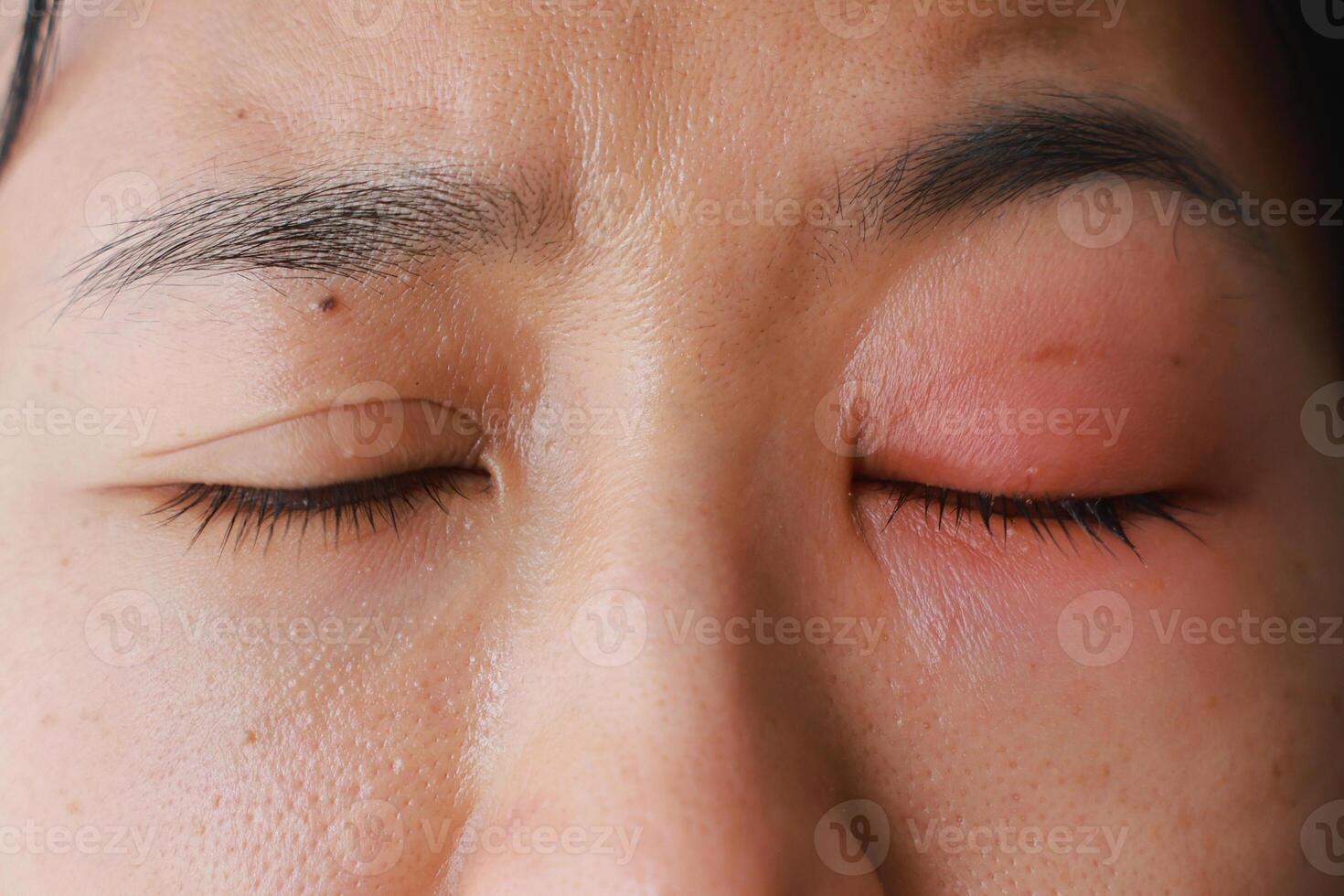 Woman's eyes become inflamed after rubbing her eyes violently. Insects entering eye cause irritation and wounds to cornea, causing eye to become swollen and red. Ophthalmologist treats eye infections. photo