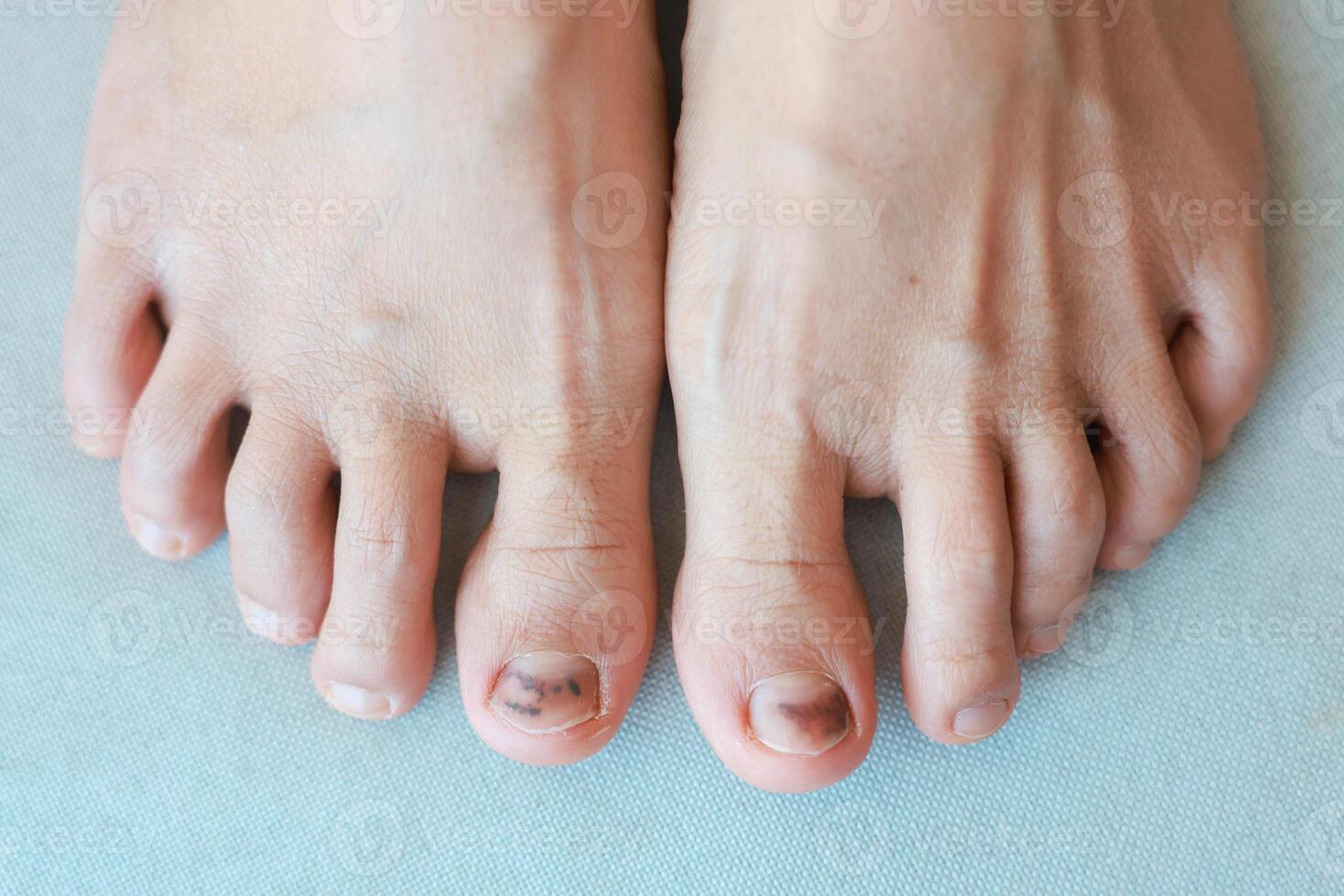 Subungual Hematoma on toenail are injuries of wearing shoes that are too tight in which bleeding develops under the nail. A crush injury to the distal phalanx fingernail or toenail, black toenail. photo