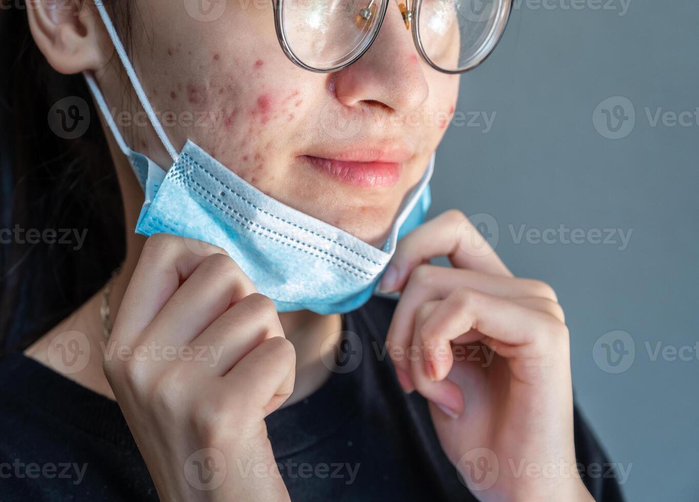 Cropped shot of young Asian woman taking off a mask for showing her face having acne inflammation. Wearing mask for a longtime can actually cause a variety of skin problems. photo