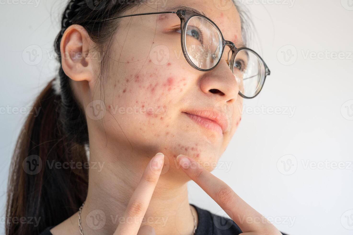 Cropped shot view of unhappy Asian woman having problems of acne inflammation on her face. photo