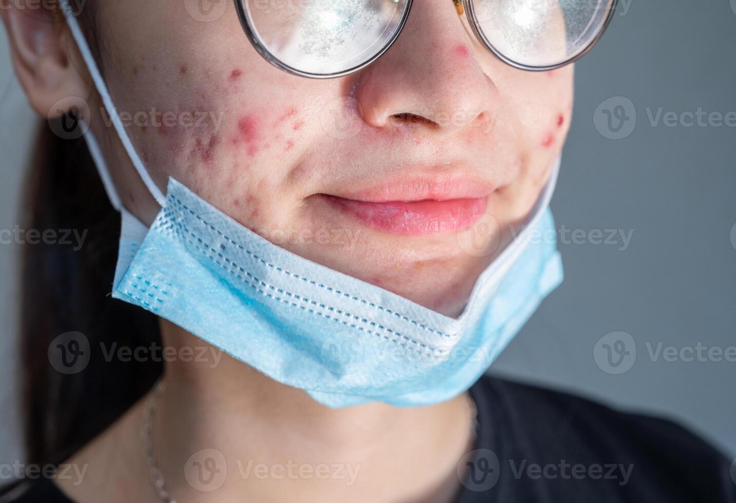 Cropped shot of young Asian woman taking off a mask for showing her face having acne inflammation. Wearing mask for a longtime can actually cause a variety of skin problems. photo