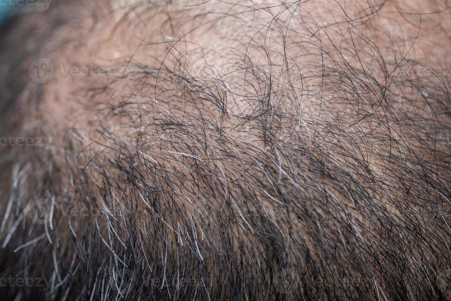 Close up of bald spot on Asian men's head with white hair and dandruff problem. Conceptual of hair problem on men's head. photo