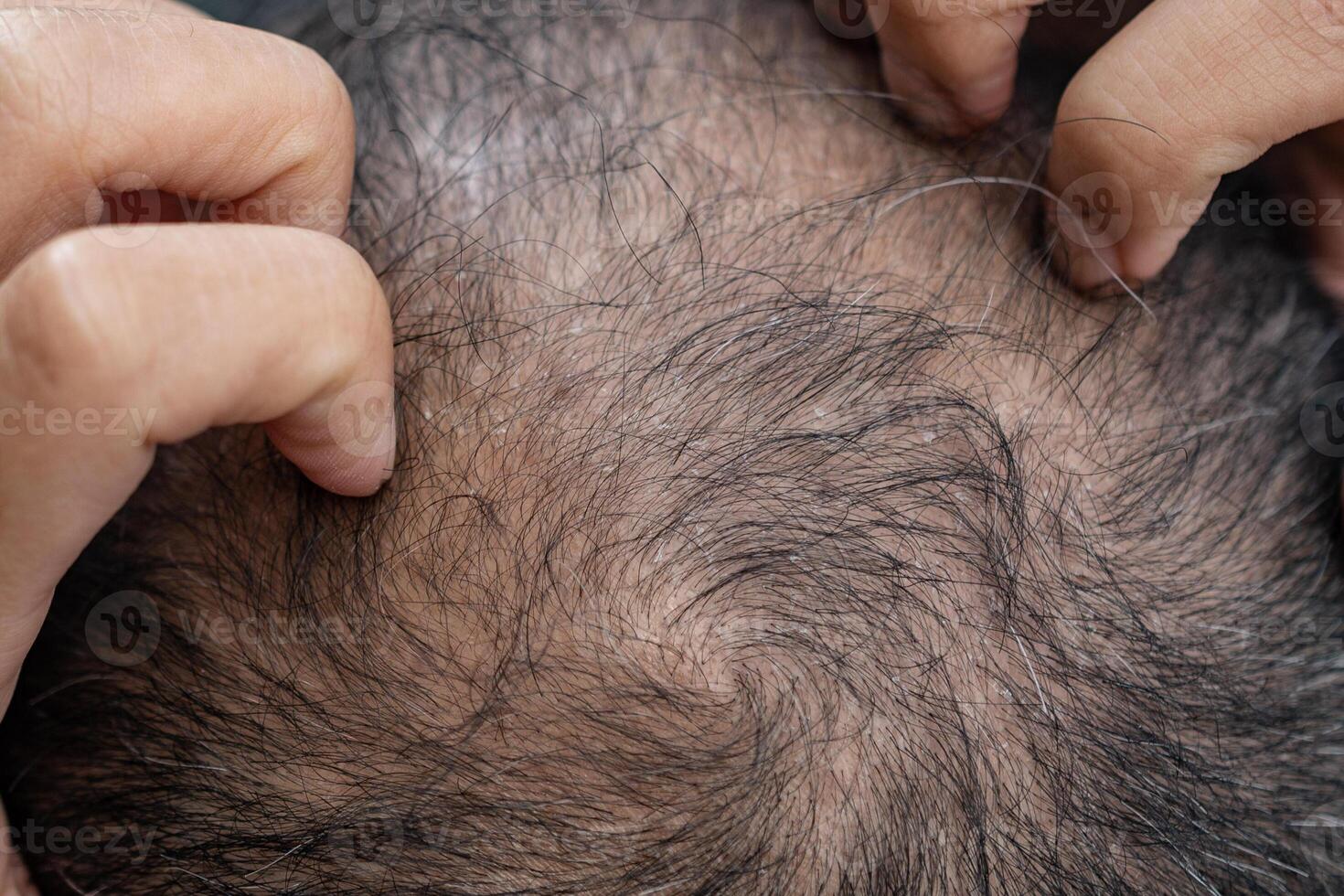 Cropped shot view of Asian man having itching problem on his scalp caused of dandruff. Dandruff is a common scalp condition in which small pieces of dry skin flake off of the scalp. photo