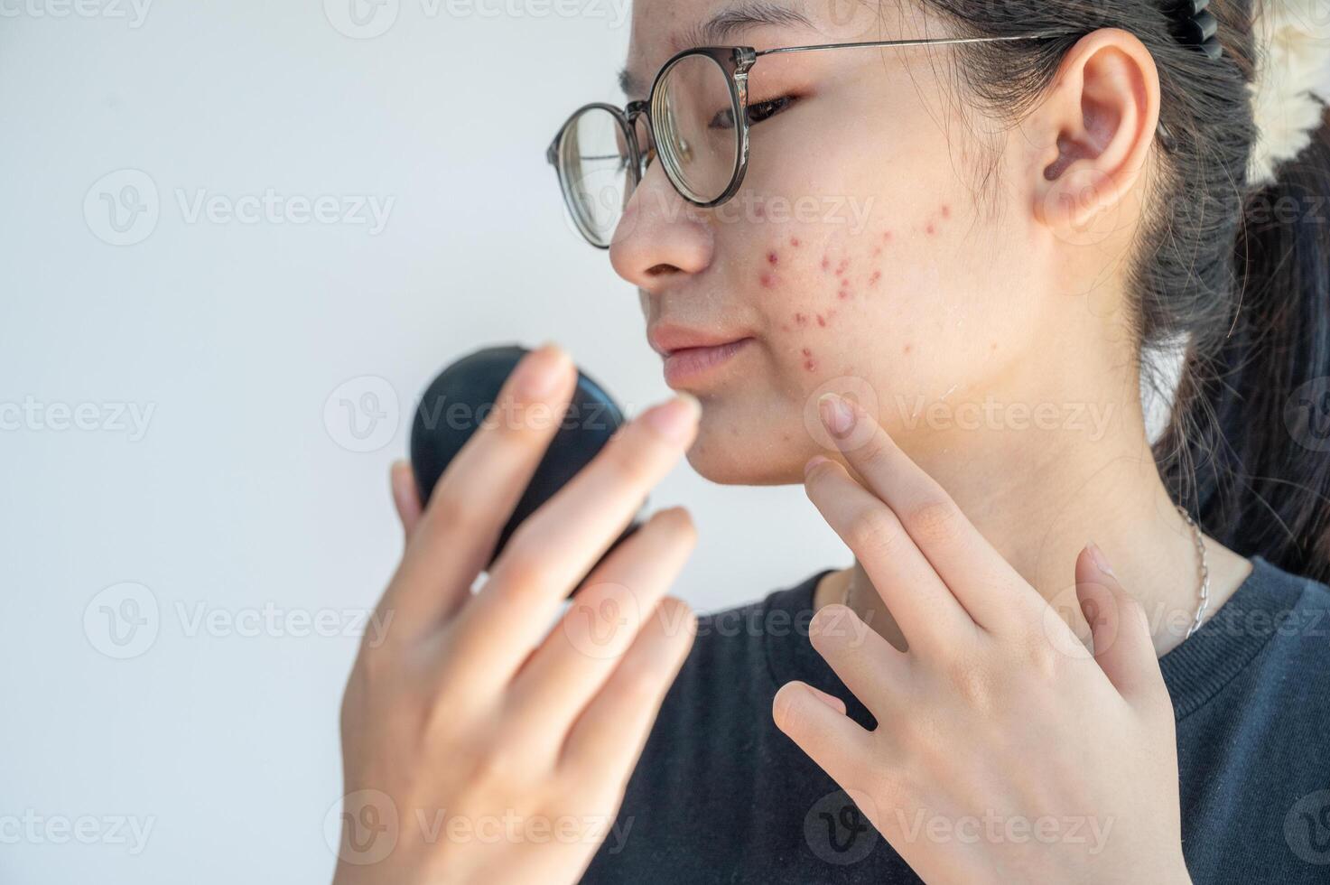 Young Asian woman worry about her face when she saw the problem of acne inflammation occur on her face. Conceptual shot of Acne and Problem Skin on female face. photo