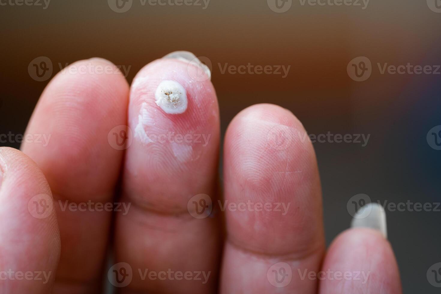 Close-up of a hand with white warts on the fingers, being treated for warts. photo