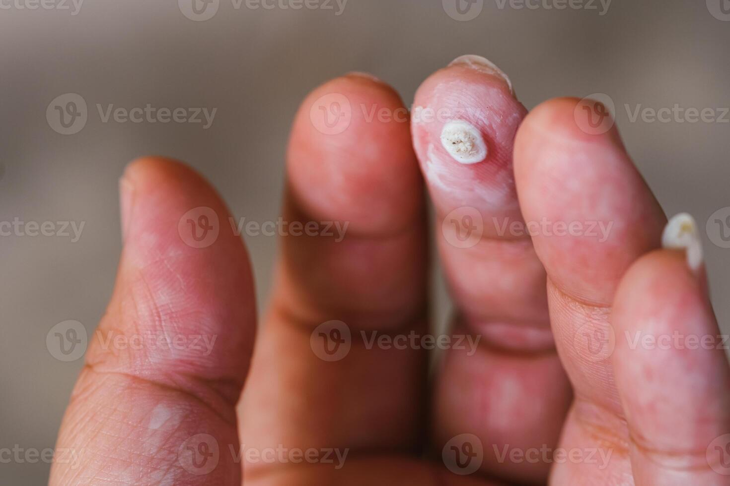 Fingers with warts, warts on hands, germs and accumulation, treatment. photo