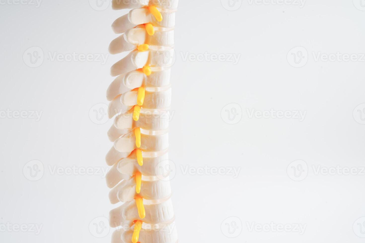 Spinal nerve and bone, Lumbar spine displaced herniated disc fragment, Model for treatment medical in the orthopedic department. photo