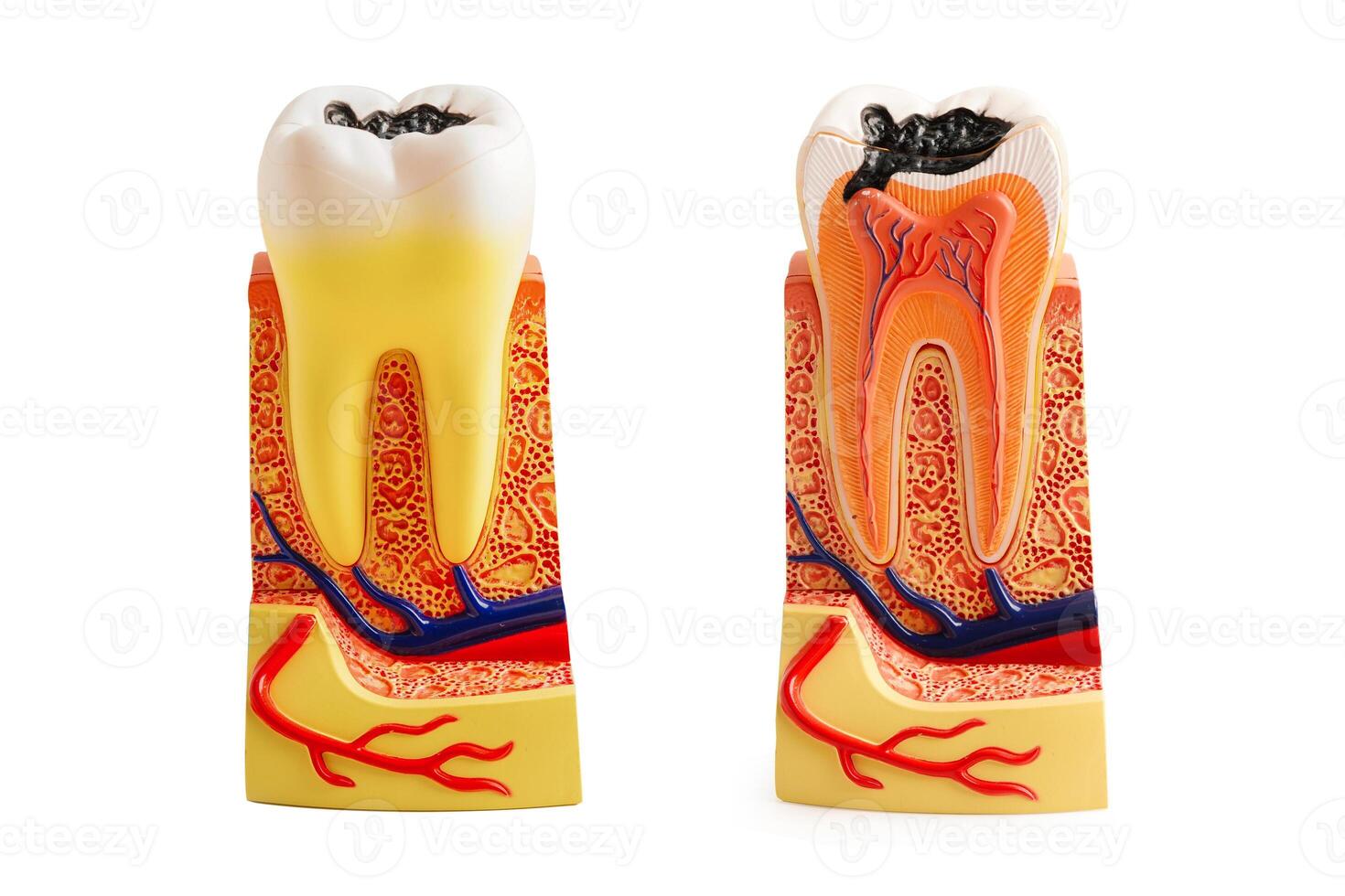 Decay tooth replace with dental implant root canal teeth model for education isolated on white background. photo