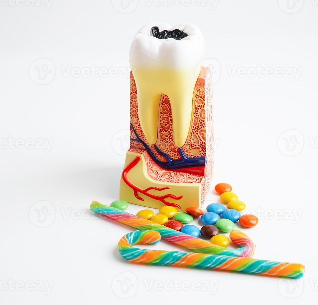 Dental implant, artificial tooth roots into jaw, root canal of dental treatment, gum disease, teeth model for dentist studying about dentistry. photo
