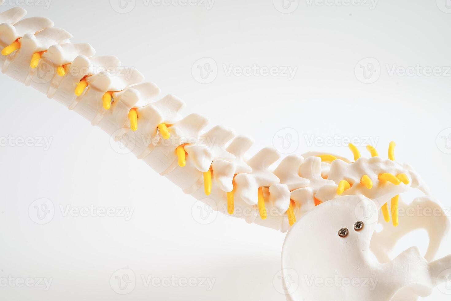 Spinal nerve and bone, Lumbar spine displaced herniated disc fragment, Model for treatment medical in the orthopedic department. photo