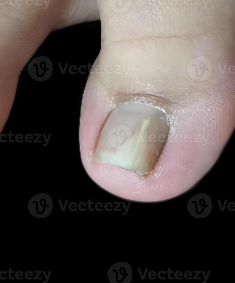 A detached toenail, indicating a fungal nail infection. Onychomycosis, also called Tinea unguium. photo