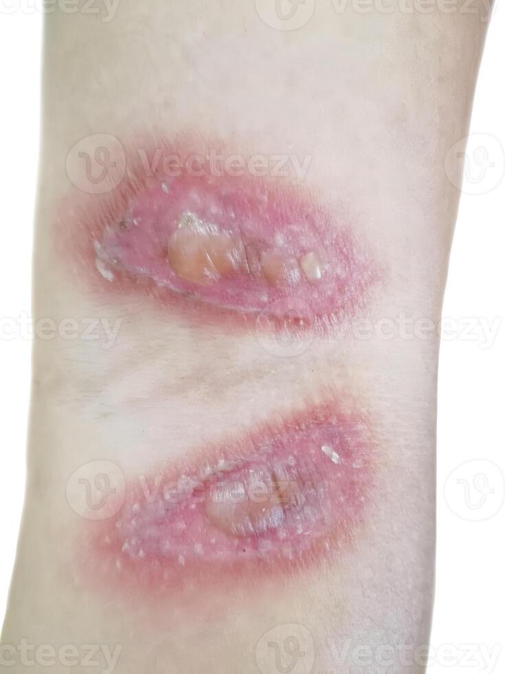 Paederus dermatitis in the arm. It is a peculiar, irritant contact one caused by a beetle photo
