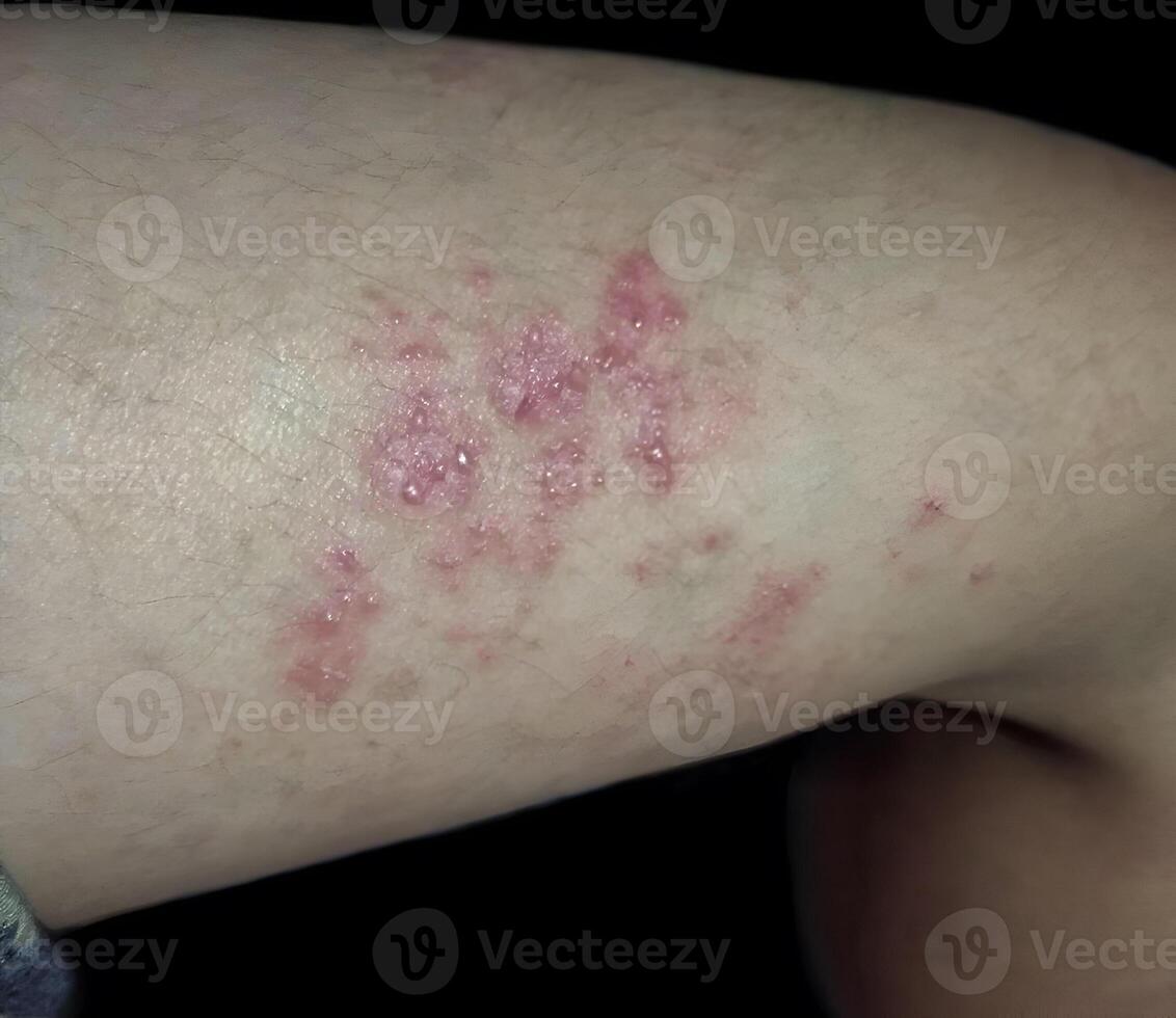 Multiple red blisters on the thigh, indicating a skin irritation or infection photo
