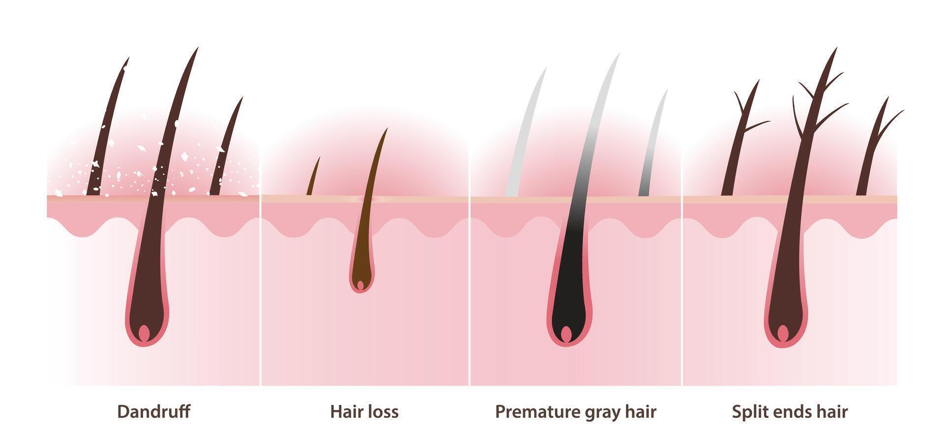 The cross section of hair problems with scalp layer illustration on white background. Dandruff, white dry flaky, scaly scalp, hair loss, alopecia, premature gray hair and split ends hair. vector