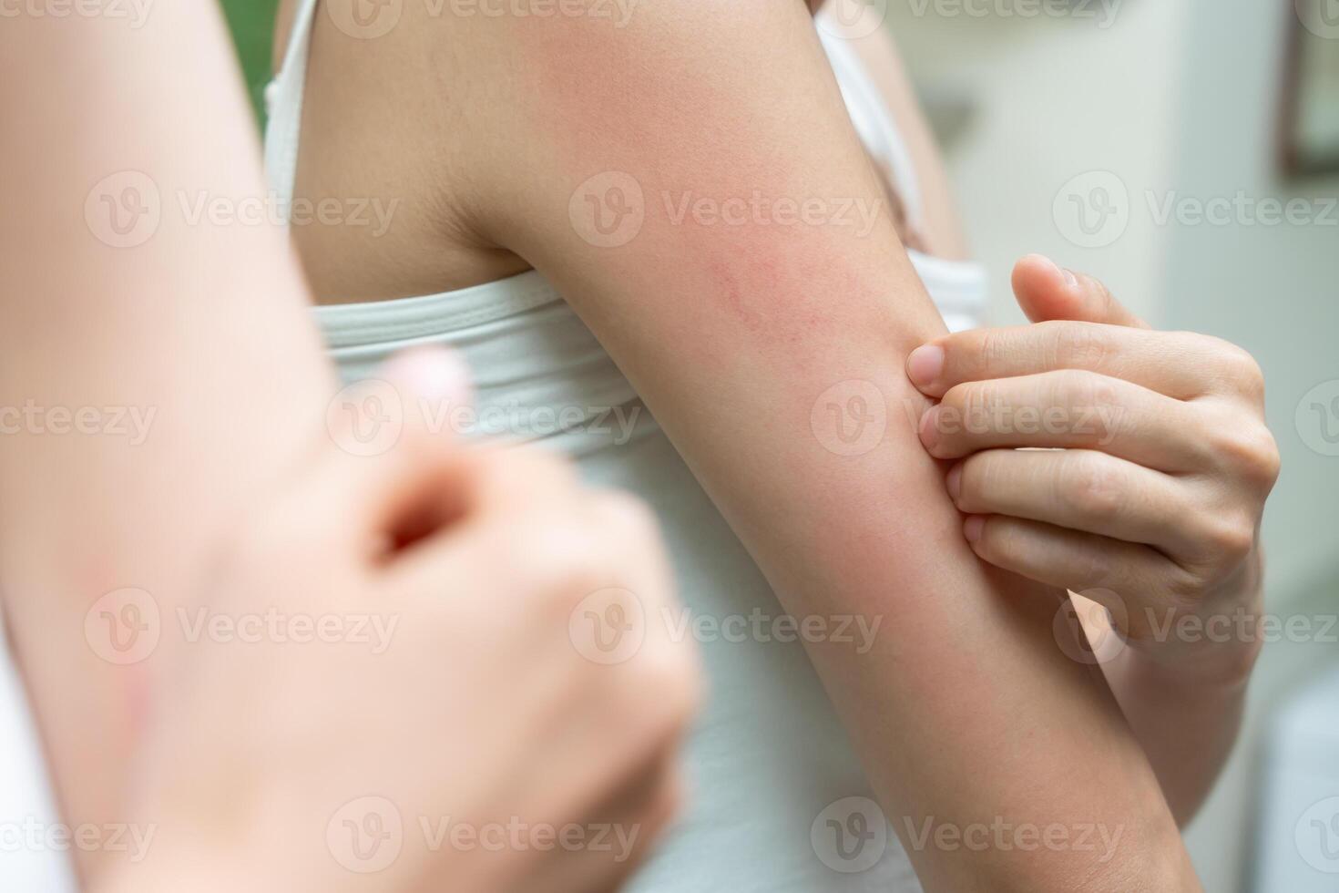 skin problem and beauty. Young woman scratch body has itchy skin from skin allergic, steroid allergy, sensitive skin, red from sunburn, chemical allergy, rash, insect bites, Seborrheic Dermatitis. photo