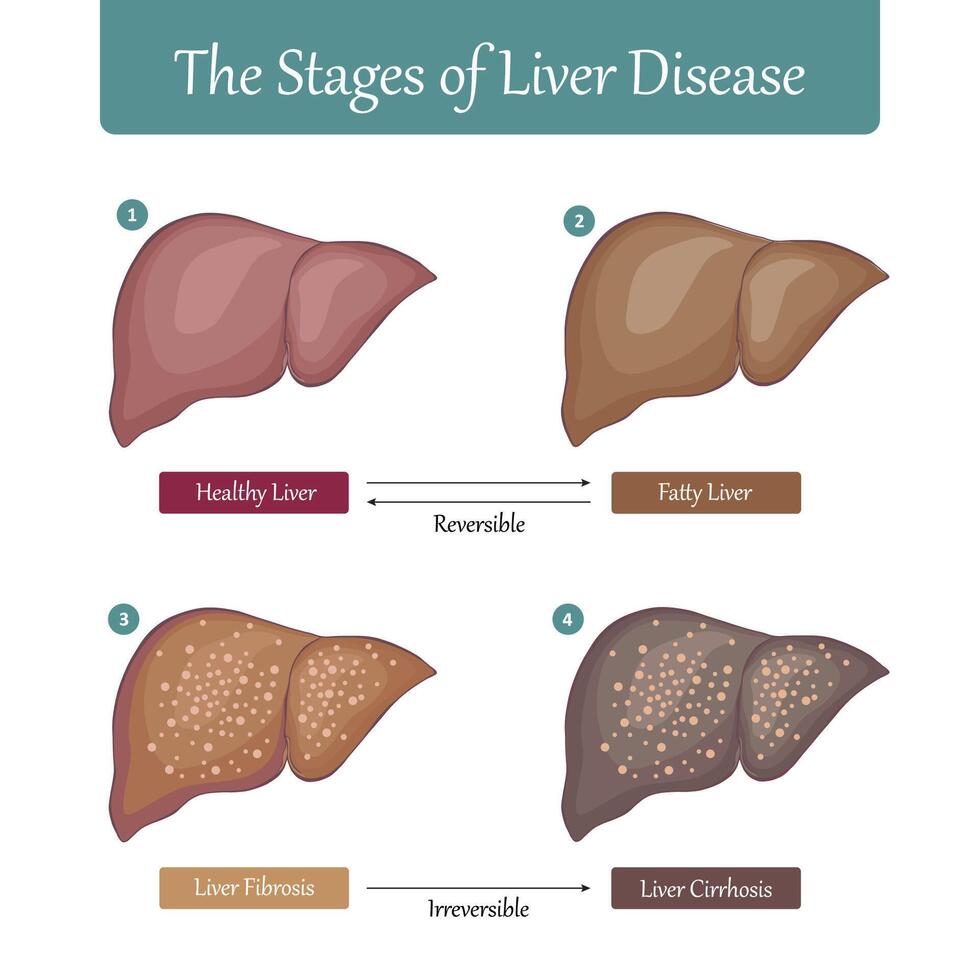 Stages of Liver Damage flat illustration. vector