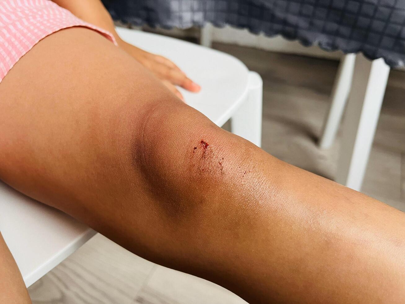 Child's scraped knees after fall from road photo