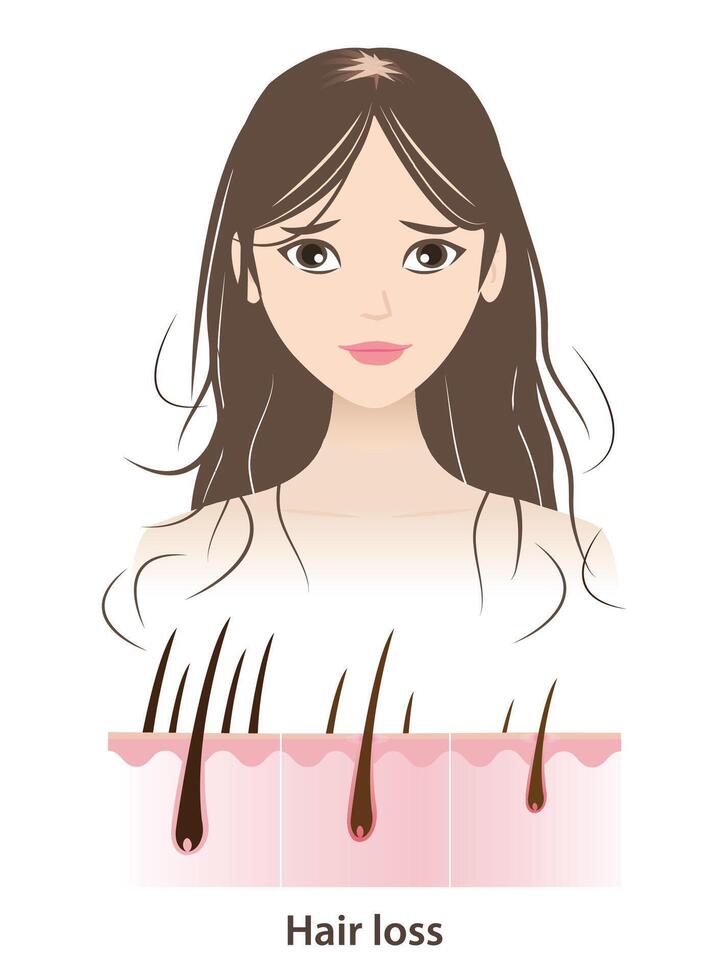 The woman with hair loss illustration on white background. Step of hair losing with scalp layer. Reduce, decrease, thin, remove, fall hair to alopecia, baldness and hairless. Hair care concept. vector
