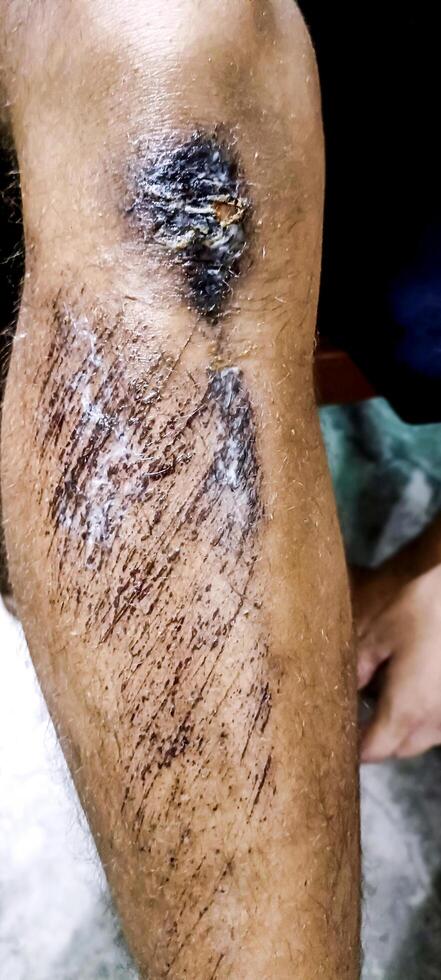 Boy was in an accident with a knee injury. The wound should be cleaned to prevent serious infections. photo