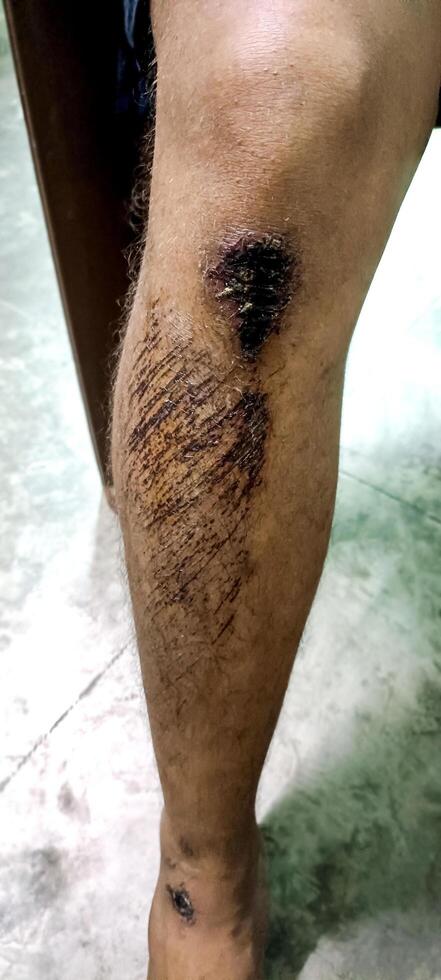 Boy was in an accident with a knee injury. The wound should be cleaned to prevent serious infections. photo