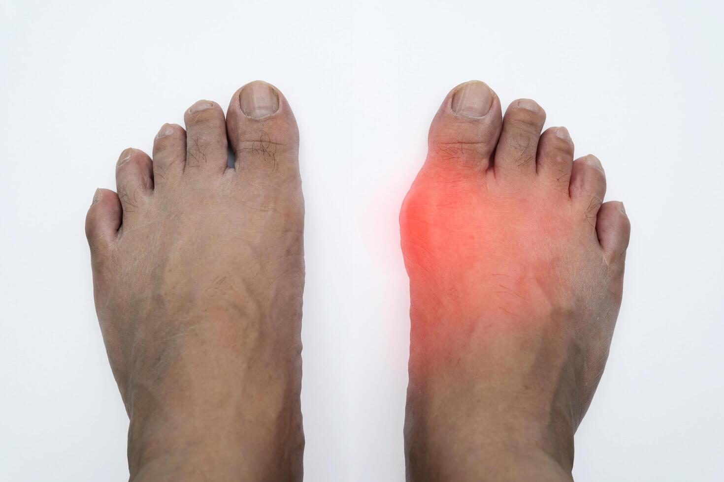 Pair of feet with deformed right toe due to painful gout inflammation. photo