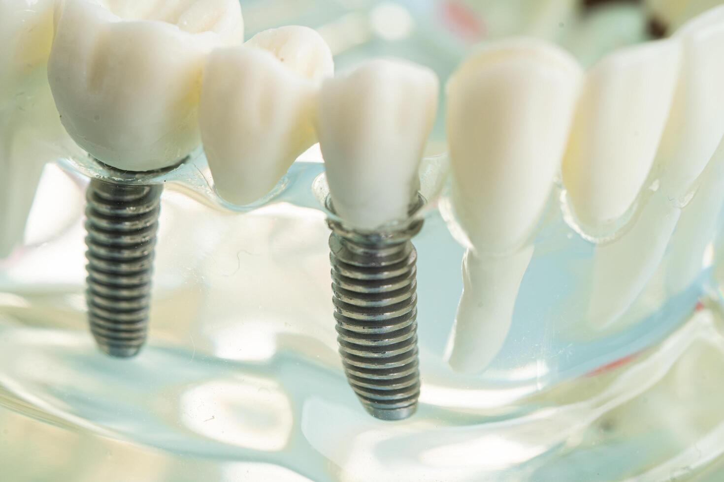 Dental implant, artificial tooth roots into jaw, root canal of dental treatment, gum disease, teeth model for dentist studying about dentistry. photo