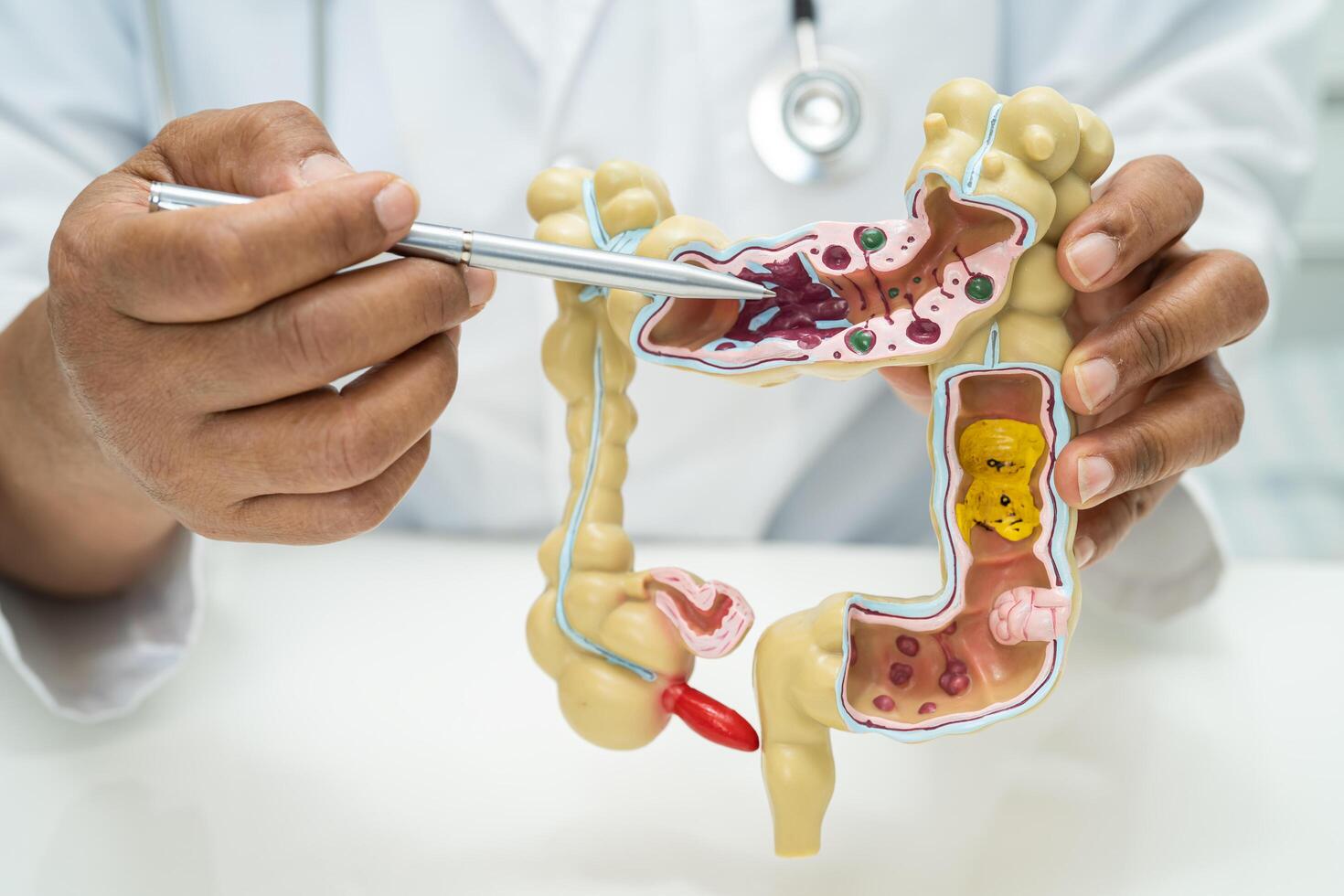 Intestine, appendix and digestive system, doctor holding anatomy model for study diagnosis and treatment in hospital. photo