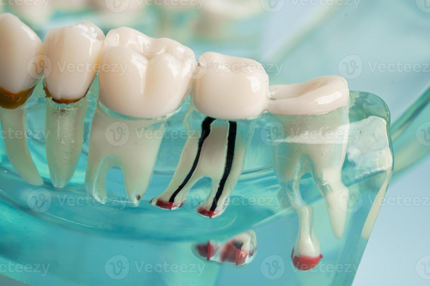 Dental implant, artificial tooth roots into jaw, root canal of dental treatment, gum disease, teeth model for dentist studying about dentistry. photo