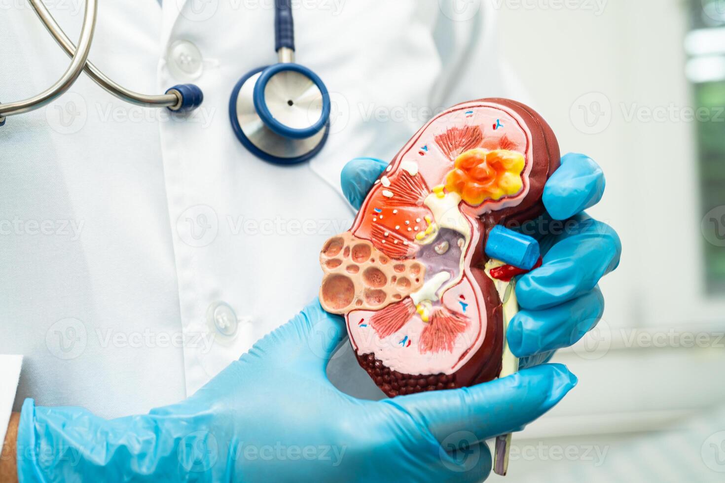 Kidney disease, Chronic kidney disease ckd, Doctor hold human model to treat and study in hospital. photo