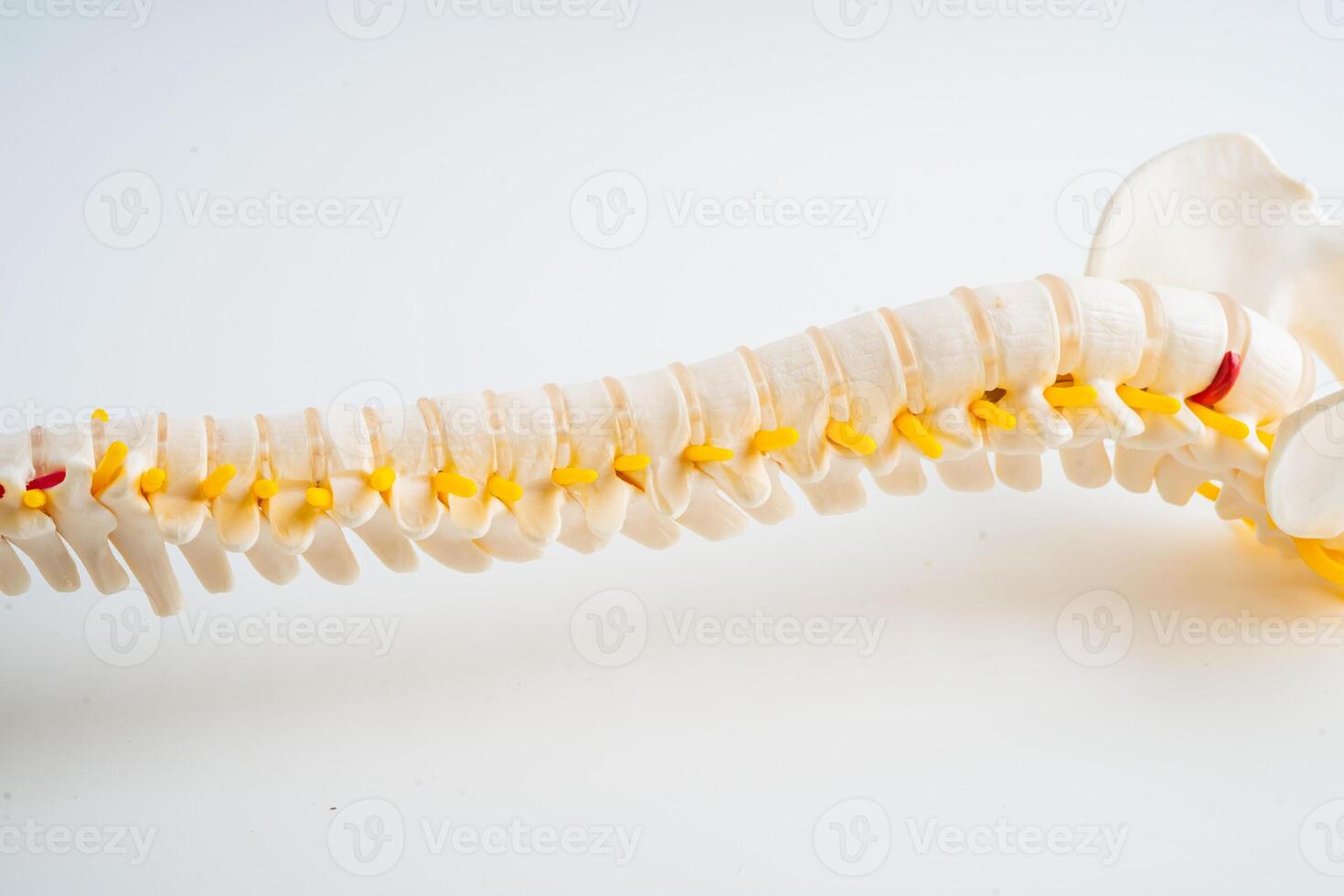 Lumbar spine displaced herniated disc fragment, spinal nerve and bone. Model for treatment medical in the orthopedic department. photo