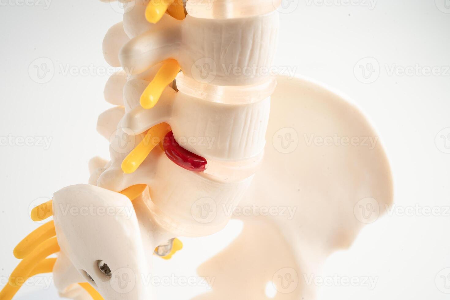 Lumbar spine displaced herniated disc fragment, spinal nerve and bone. Model for treatment medical in the orthopedic department. photo