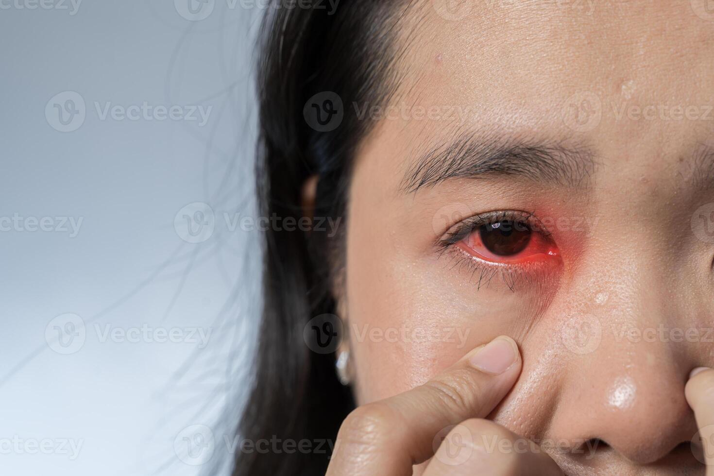 Close up portrait of women with red eye before and after treatment or eye drop. photo