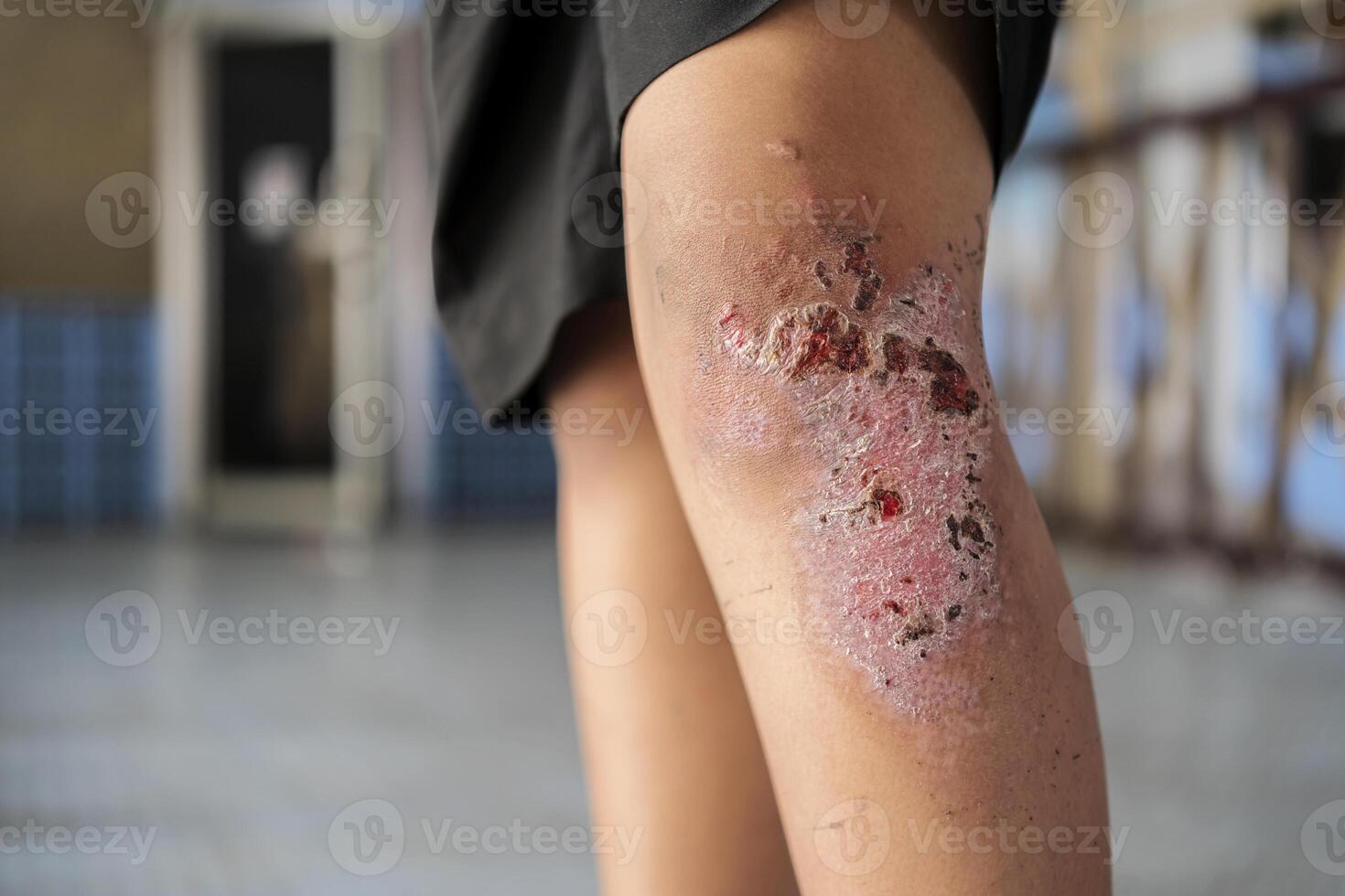 Dry scab on the wounded knee of an boy photo