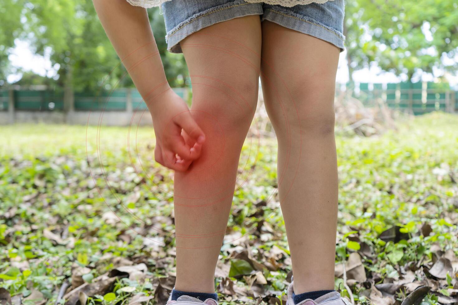 Asian girl has allergies with mosquitoes bite and itching her leg. Repellent, Dengue virus, Yellow fever, West nile, Malaria, Diseases Spread by Mosquitoes concept photo