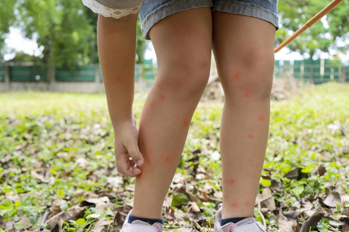 Asian girl has allergies with mosquitoes bite and itching her leg photo