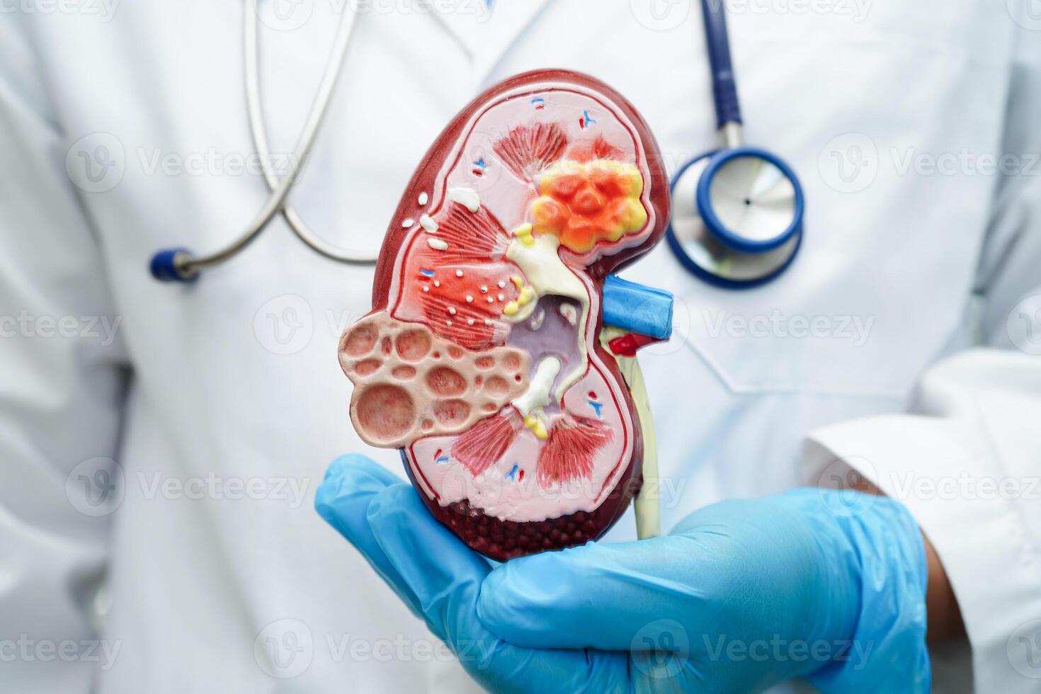 Chronic kidney disease, doctor with model for treatment urinary system, urology, Estimated glomerular filtration rate eGFR. photo