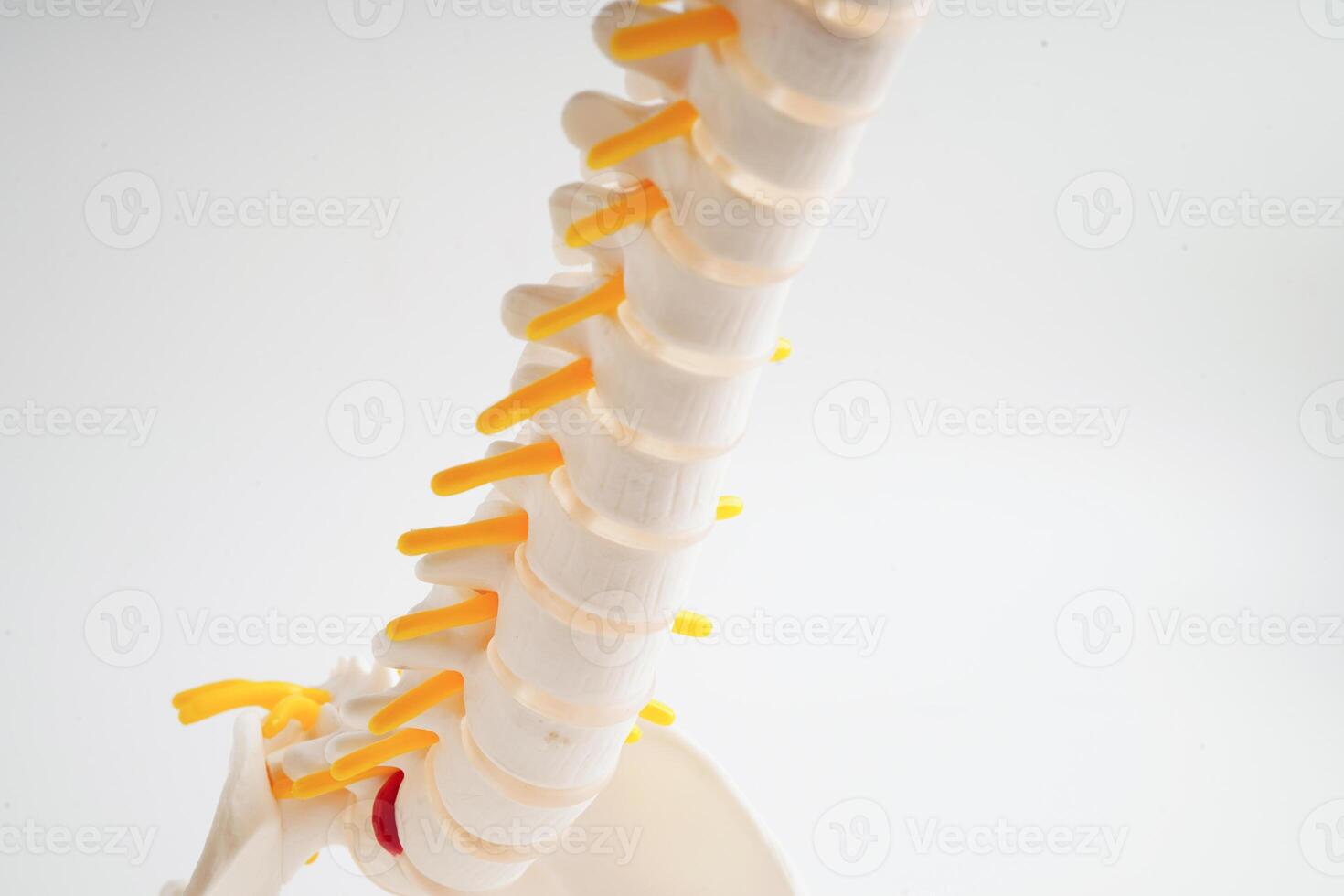 Spinal nerve and bone, Lumbar spine displaced herniated disc fragment, Model for treatment medical in the orthopedic department. photo