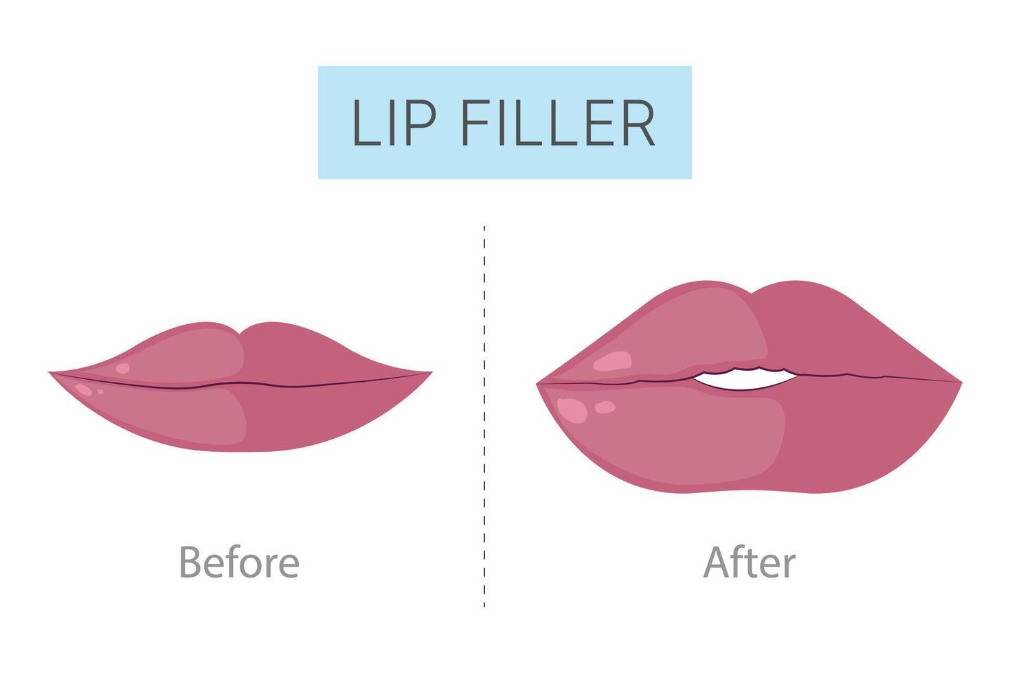 lip filler before and after, realistic 1ml lip filler before and after thin lips vector