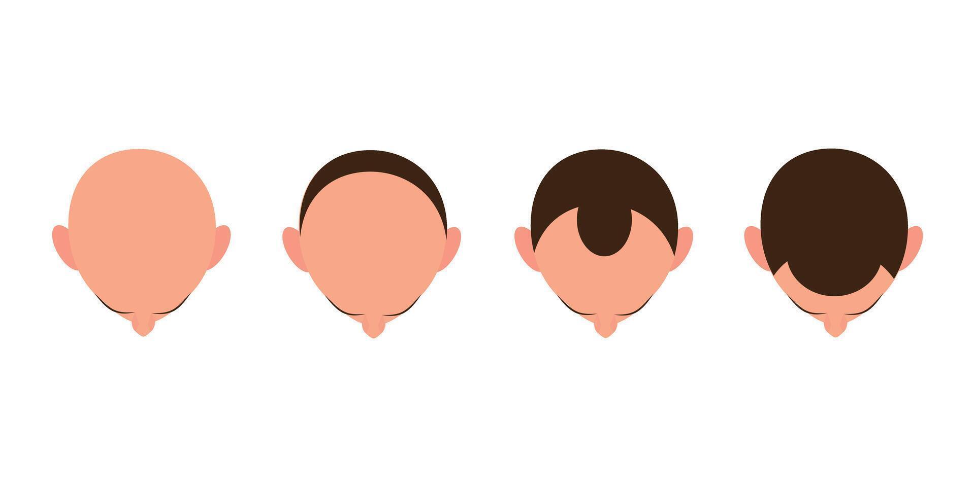 Hair loss bald head alopecia transplant growth top view. Hair loss men top view alopecia scalp problem vector