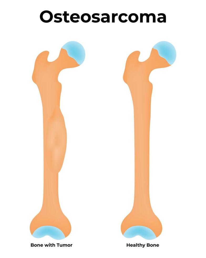 Osteosarcoma Science Design Illustration Diagram vector