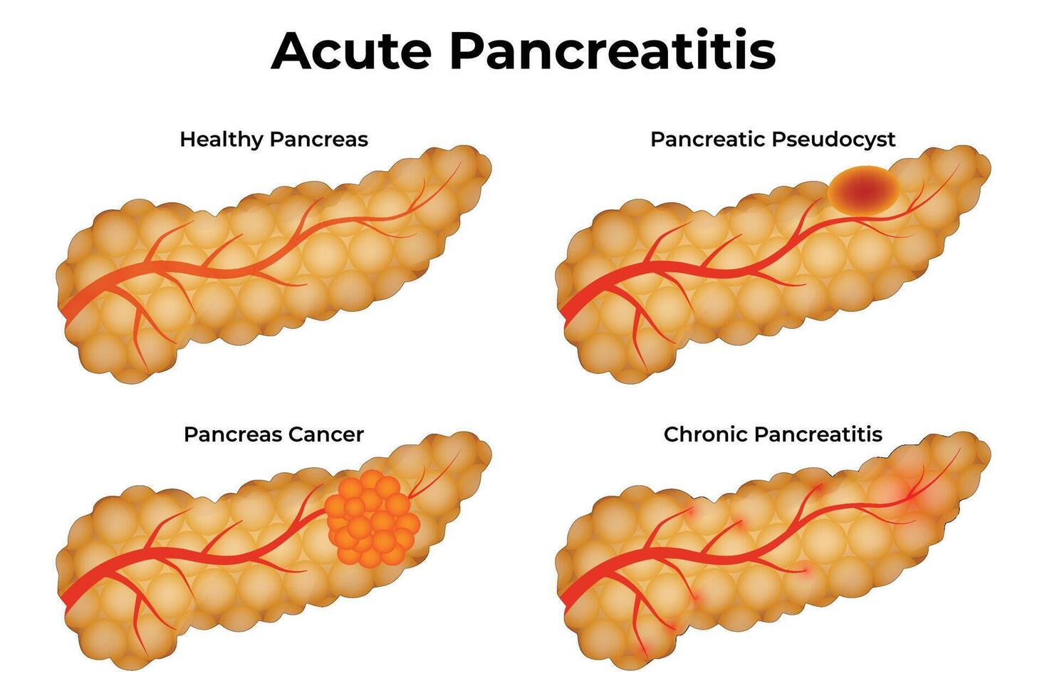 Acute Pancreatitis Science Design Illustration Diagram vector