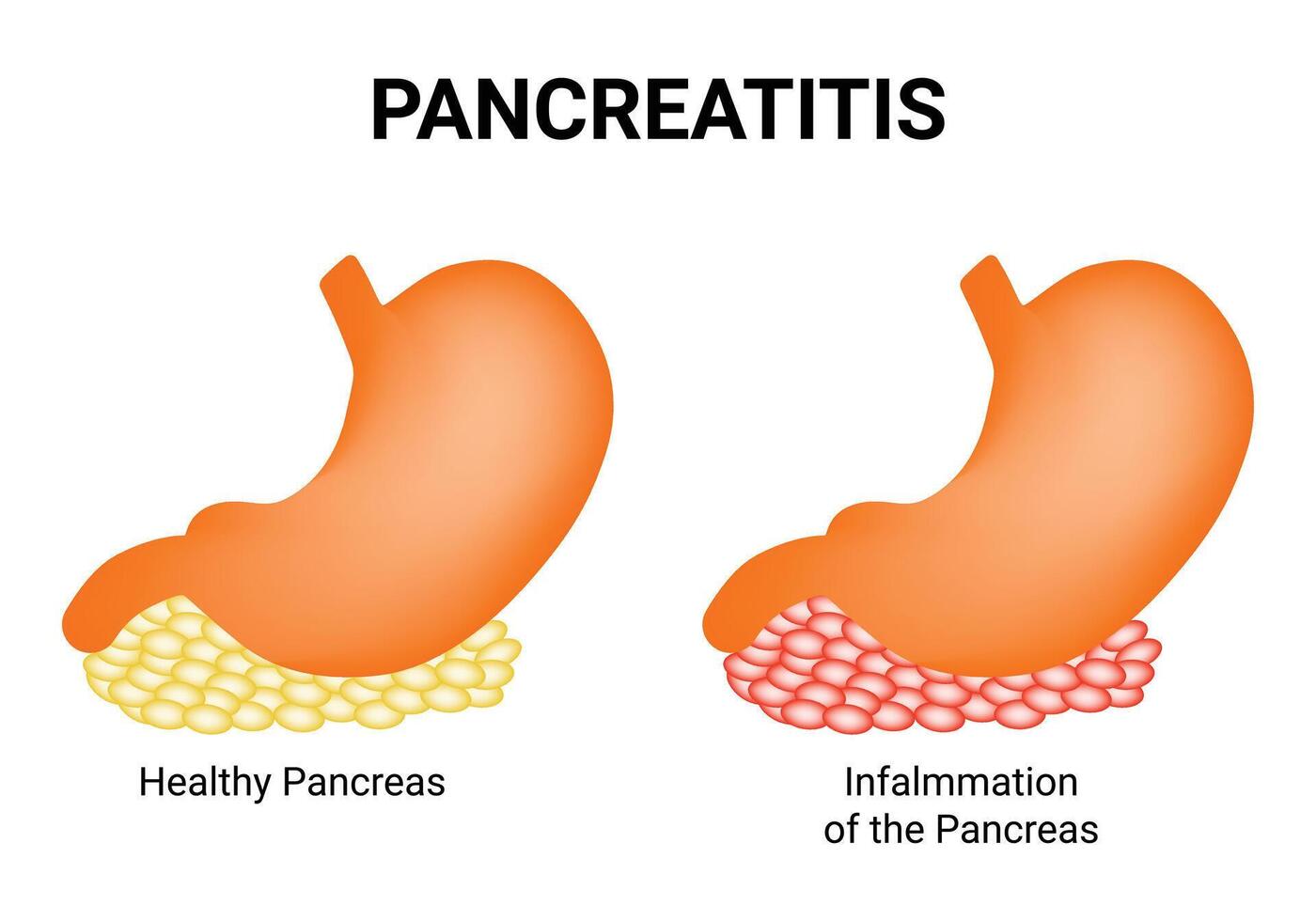 Pancreatitis Science Design Illustration Diagram vector