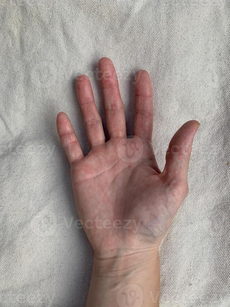 peeling dry hand with infected on plain background photo