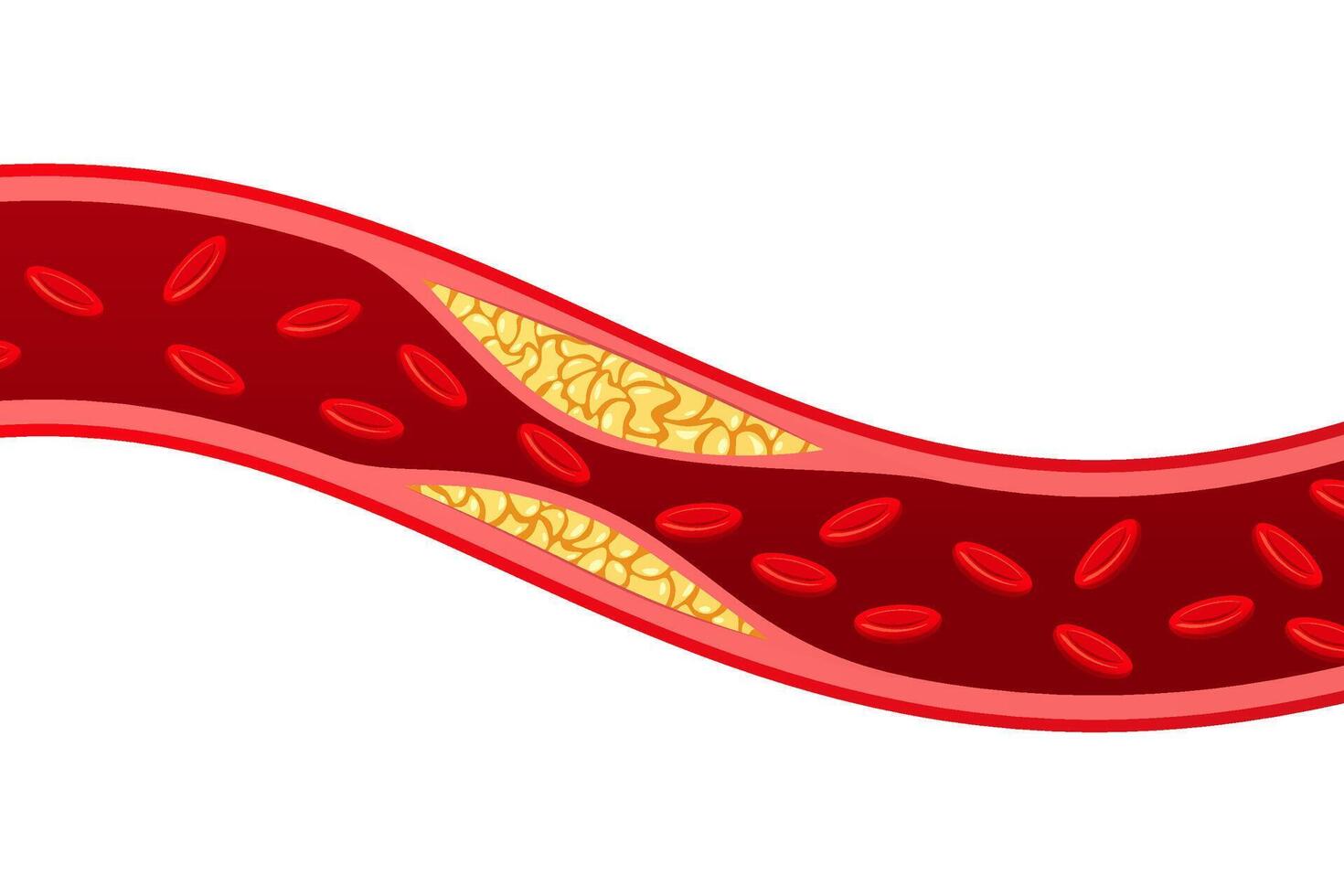 Artery with cholesterol plaque buildup isolated on white background. vector