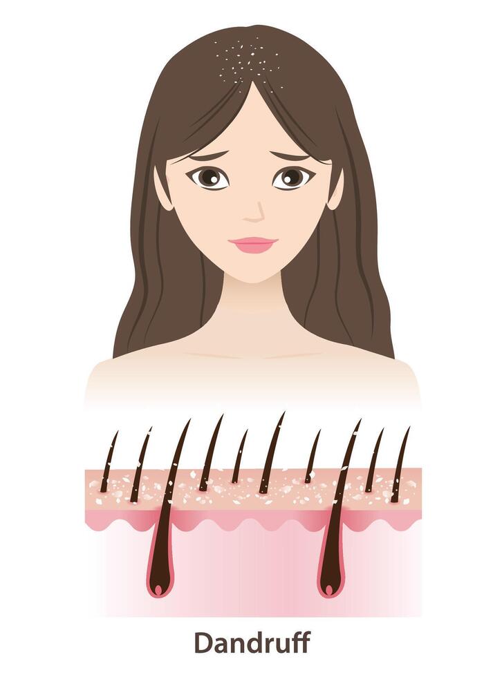The woman with dandruff on hair illustration isolated on white background. Cross section of white dry flakes, scaly patches on scalp layer. Hair care and problem concept. vector